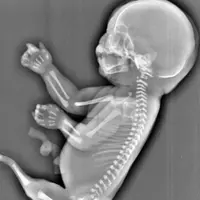 Mengetahui janinnya mengidap Sindrom Mermaid, ibu muda asal Cina ini pilih aborsi. | via: thesun.co.uk