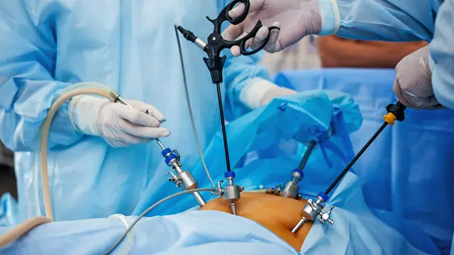 Ilustrasi teknik Laparoscopy.