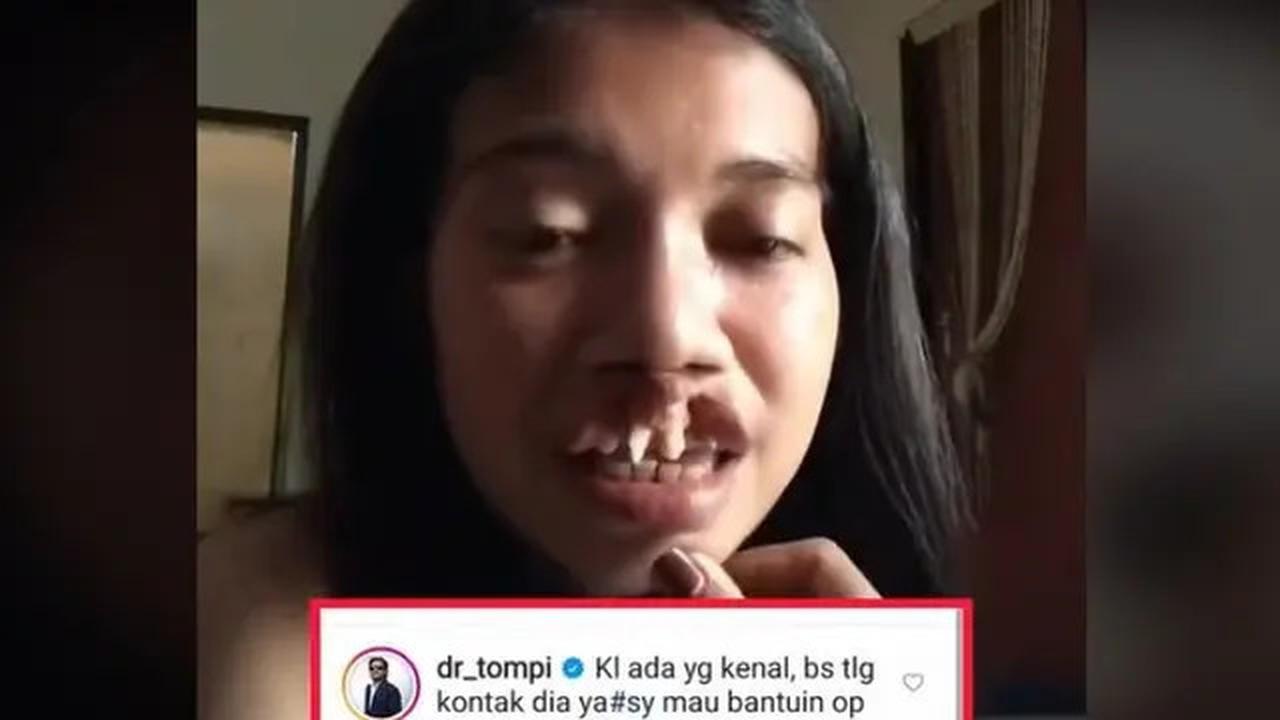 Viral Video Wanita Berbibir Sumbing tapi Bersuara Merdu, Komentar Tompi Jadi Sorotan