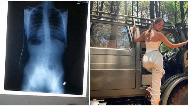 6 Artis Ini Mengidap Skoliosis, Perjuangannya untuk Sembuh Bikin Salut
