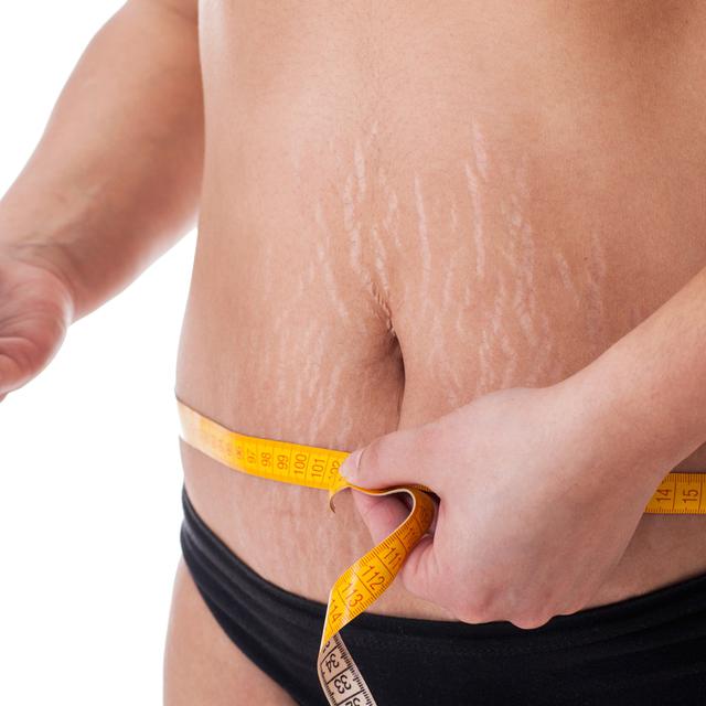 Mitos Dan Fakta Seputar Selulit Yang Perlu Kamu Ketahui Health Liputan6 Com