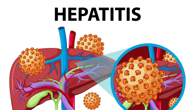 Penyakit Hepatitis dan jenis-jenisnya yang perlu diketahui