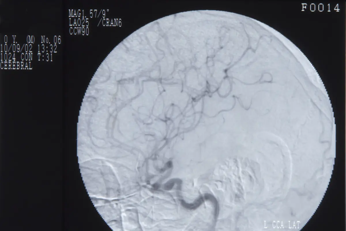 Prosedur Brain Washing (Cerebral Angiography)