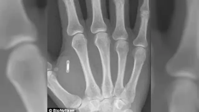 Tanam Microchip Dalam Tubuh Manusia, Berani?