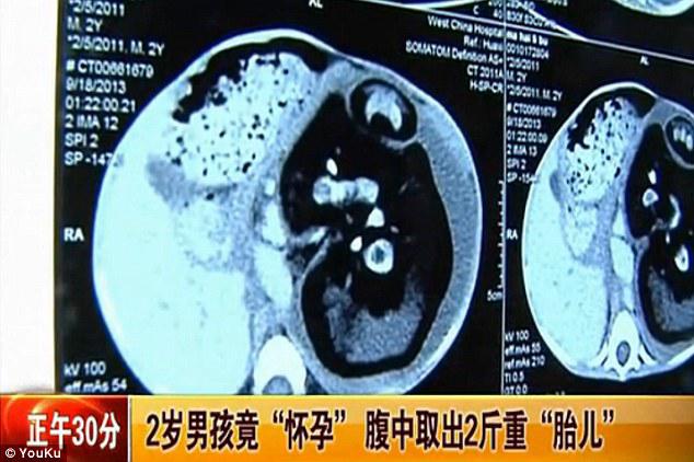 Hasil scan menunjukkan kalau ada janin yang merupakan kembaran Xiao Feng di dalam perutnya (c) dailymail.co.uk