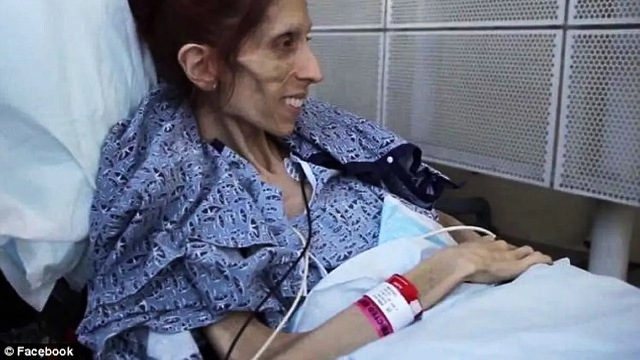 Rachael Farrokh, Penderita Anorexia yang Kini Kembali Ceria