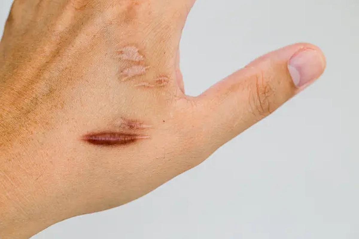 Mengungkap Keloid, Penyebab dan Cara Efektif Mencegahnya