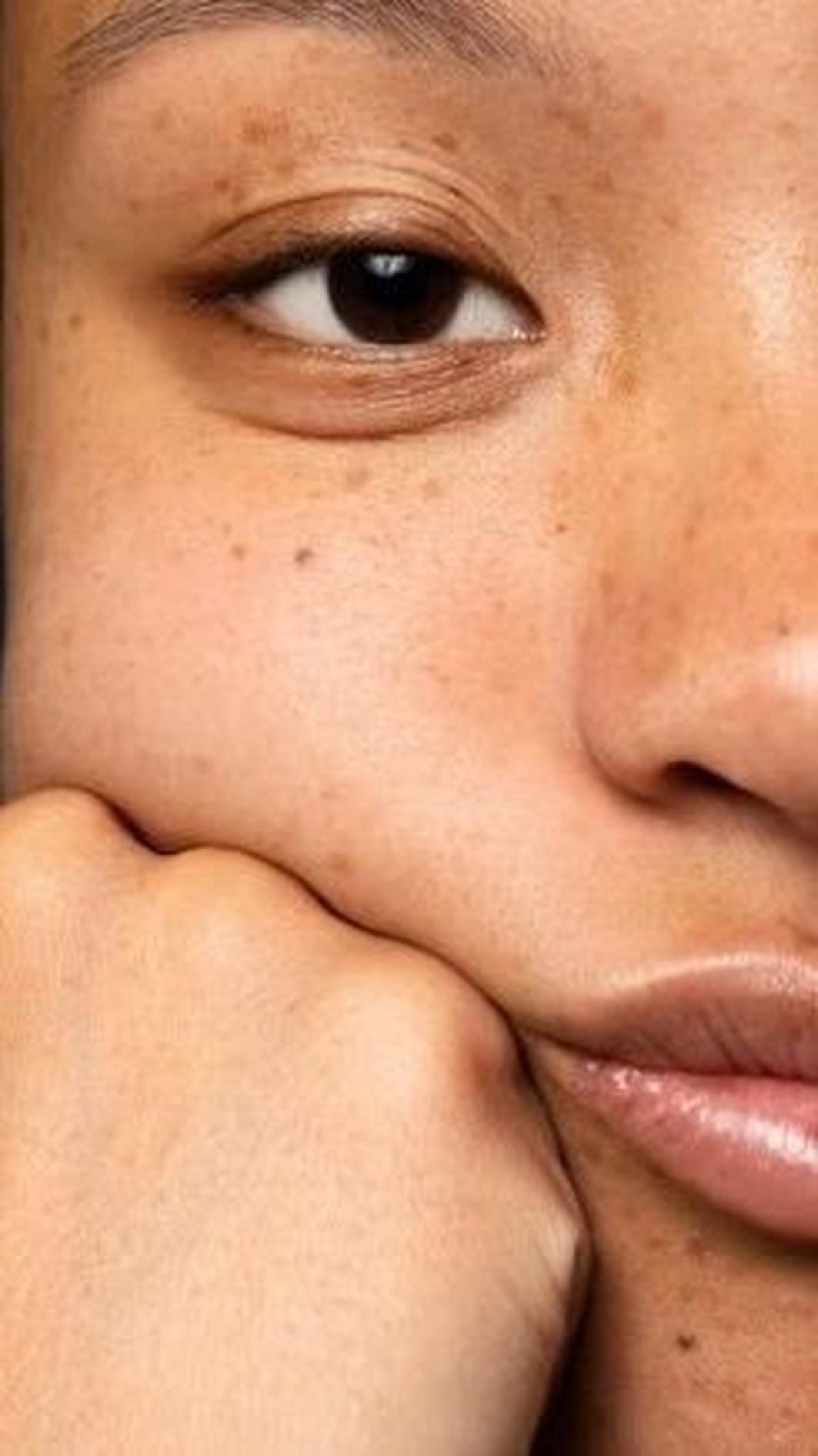 Pertanyaan Seputar Flek Hitam