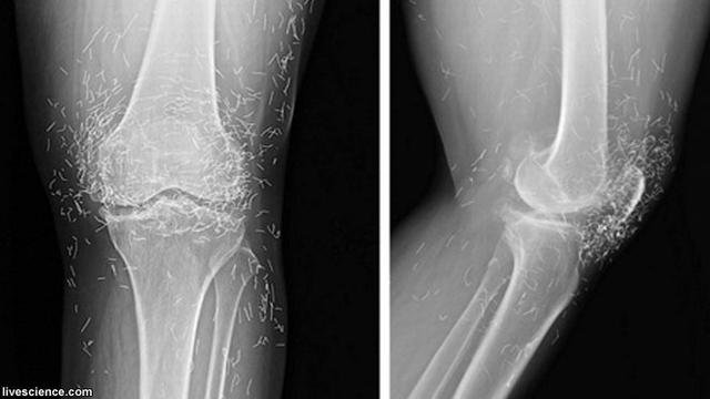 Sinar X Menguak Tambang Emas Di Lutut Perempuan Korsel Global Liputan6 