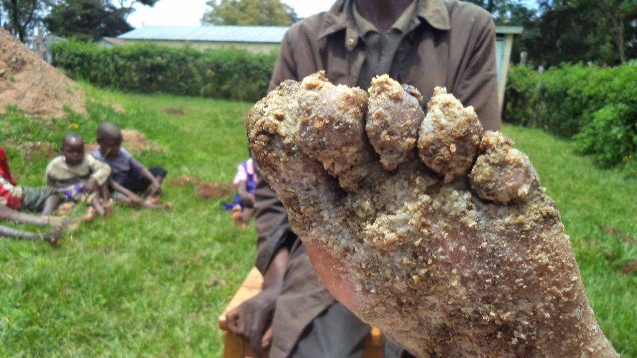 Dampak terkena jigger