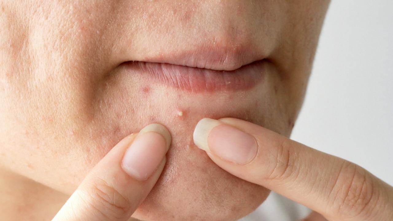 Acne Prone Skin