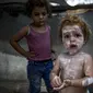 Seorang anak pengungsi Sham al-Hessi yang menderita penyakit kulit diolesi krim kulit saat berpose untuk difoto, di kamp tenda darurat di Deir al-Balah, Jalur Gaza tengah, Senin (29/7/2024). (AP Photo/Abdel Kareem Hana)