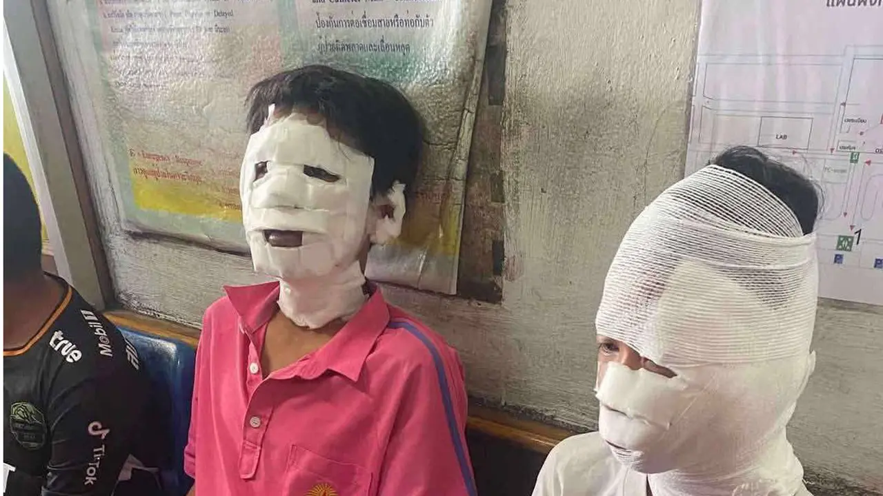 Kepala siswa terlihat diperban setelah terbakar saat melakukan percobaan sains di provinsi Phetchabun, Thailand. (Foto: Halaman Facebook berita daring Phetchabun)