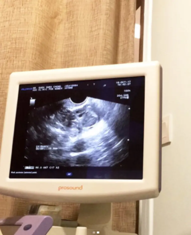 Chacha Frederica pamer hasil USG rahimnya. (Instagram/chachadico)