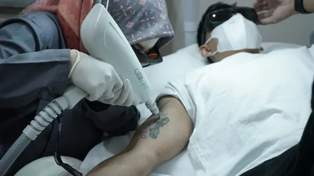 Menghapus tato