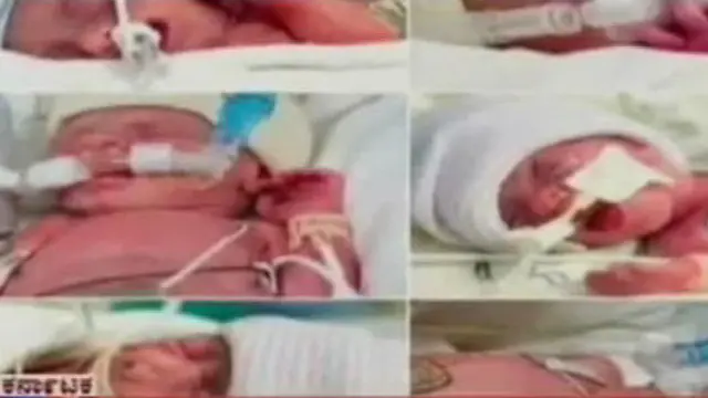 Menakjubkan! Wanita di Ceko Lahirkan 5 Bayi Kembar