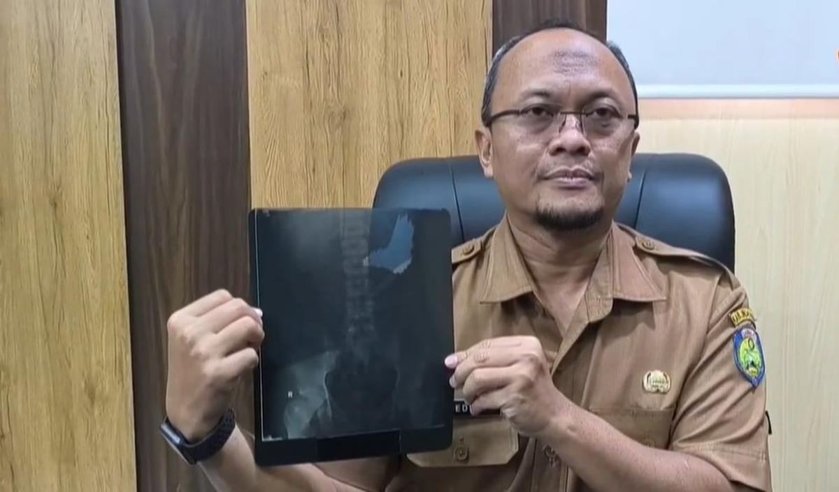 Kondisi Paku di Dalam Perut Berkarat