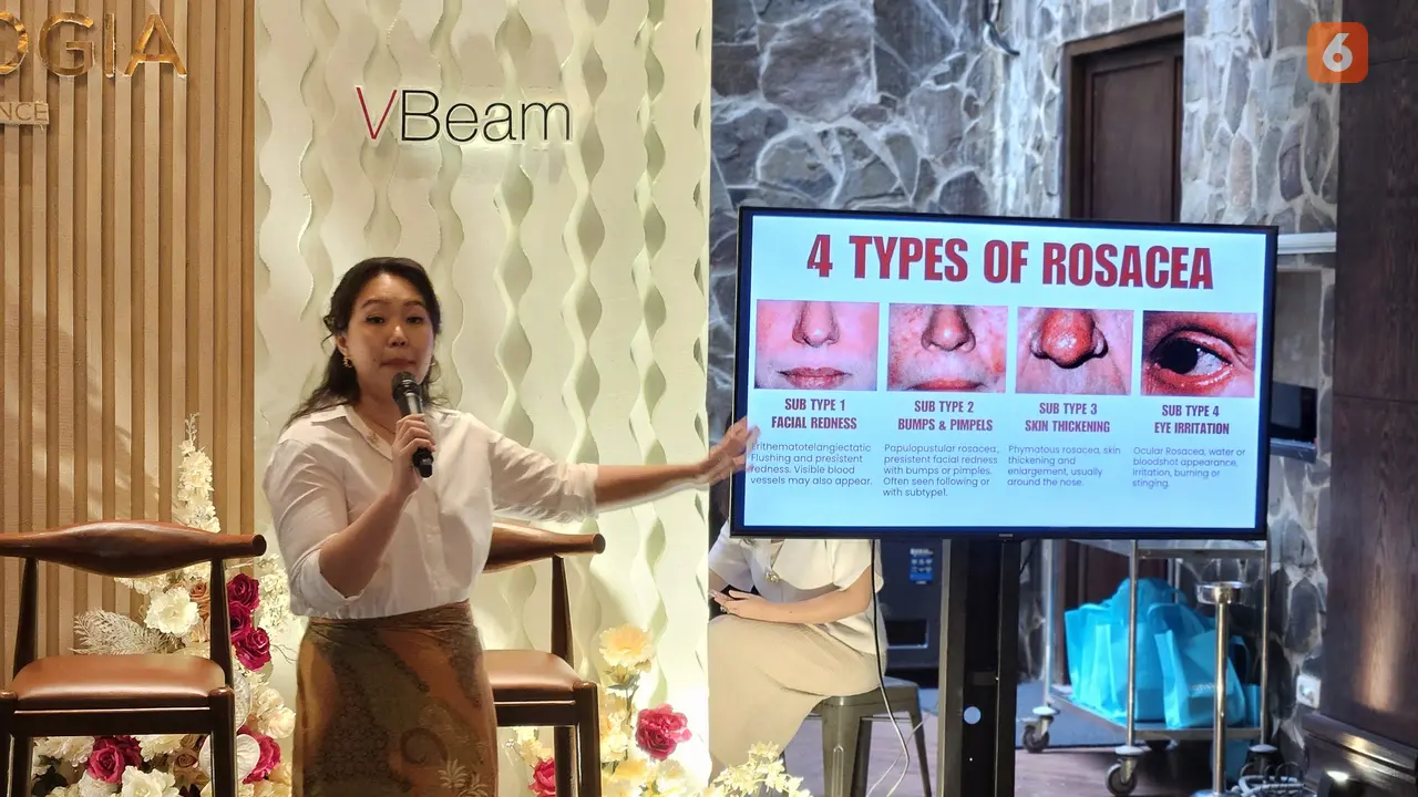 Simak penjelasan lengkap dari dr. Nani Kumala Dewi, Sp.DVE, tentang perawatan yang tepat untuk rosacea, penyakit kulit yang sering disalahartikan sebagai jerawat (Foto: Aditya Eka Prawira/Liputan6.com)