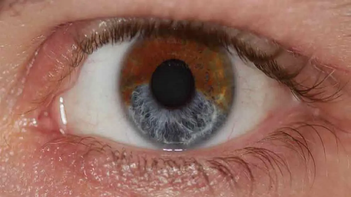 Радужка содержит пигмент. Меланин цвет глаз. Изменение цвета радужной оболочки глаза.