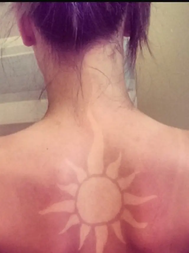 Sunburn Tattoo