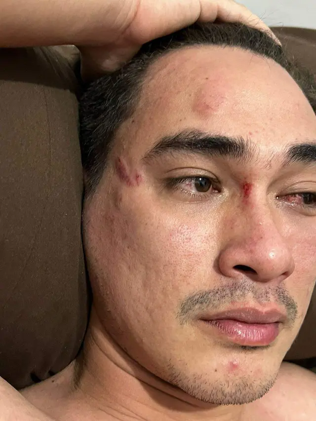 Rico Valentino usai menjalani visum kasus pemukulan