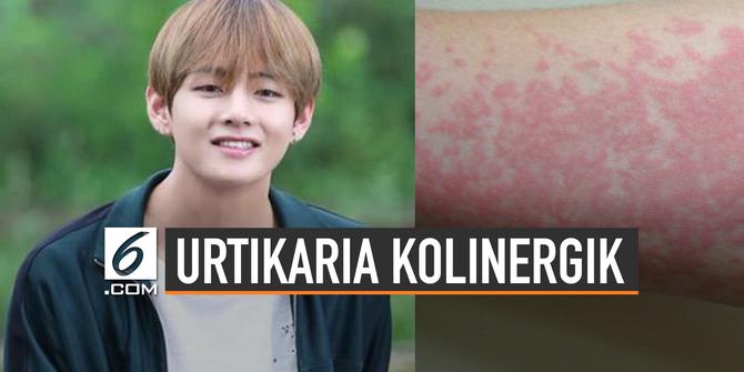 VIDEO: Kenali Urtikaria Kolinergik yang Dialami V BTS