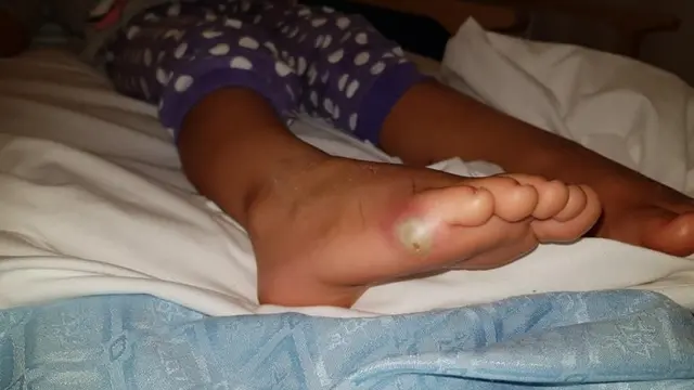 Gunakan Sepatu Tanpa Kaus Kaki, Gadis Cilik Ini Hampir Meninggal