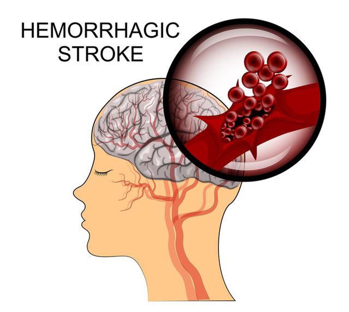 Kenali Risiko Stroke Sejak Dini, Begini Gejala dan Cara Penanganannya