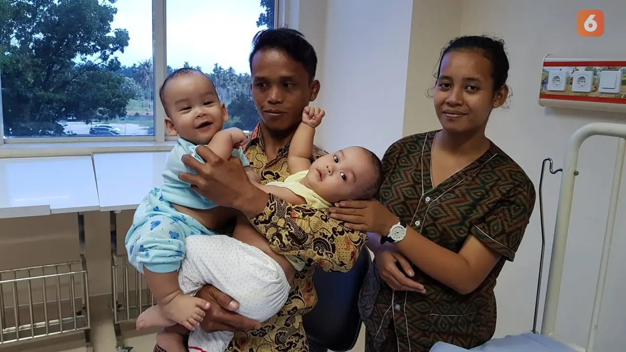 Bayi Kembar Siam