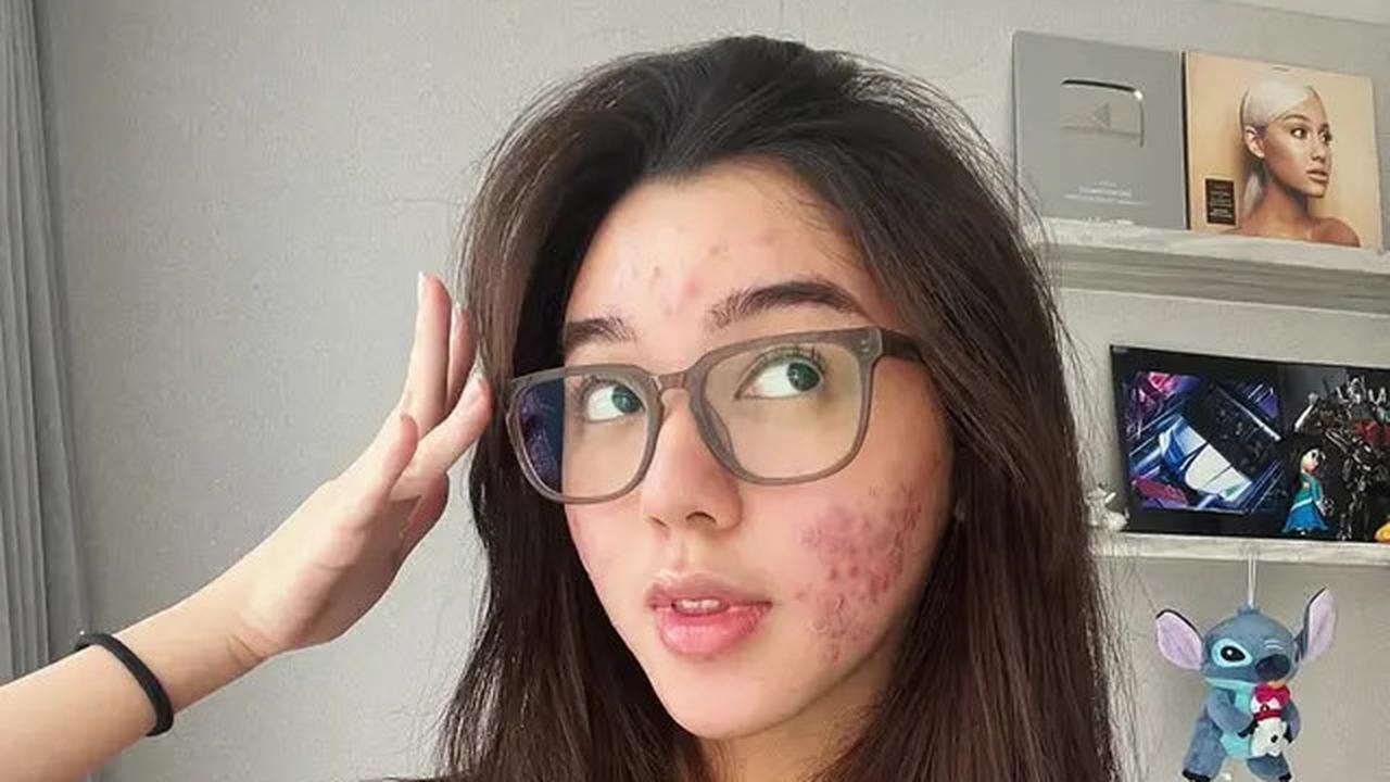 6 Potret Wajah Gabriella Ekaputri Berjerawat, Tetap Percaya Diri Tampil Natural