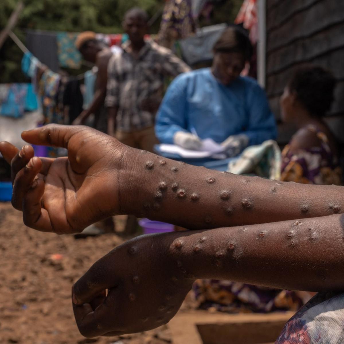 Wabah Mpox atau Cacar Monyet di Burundi