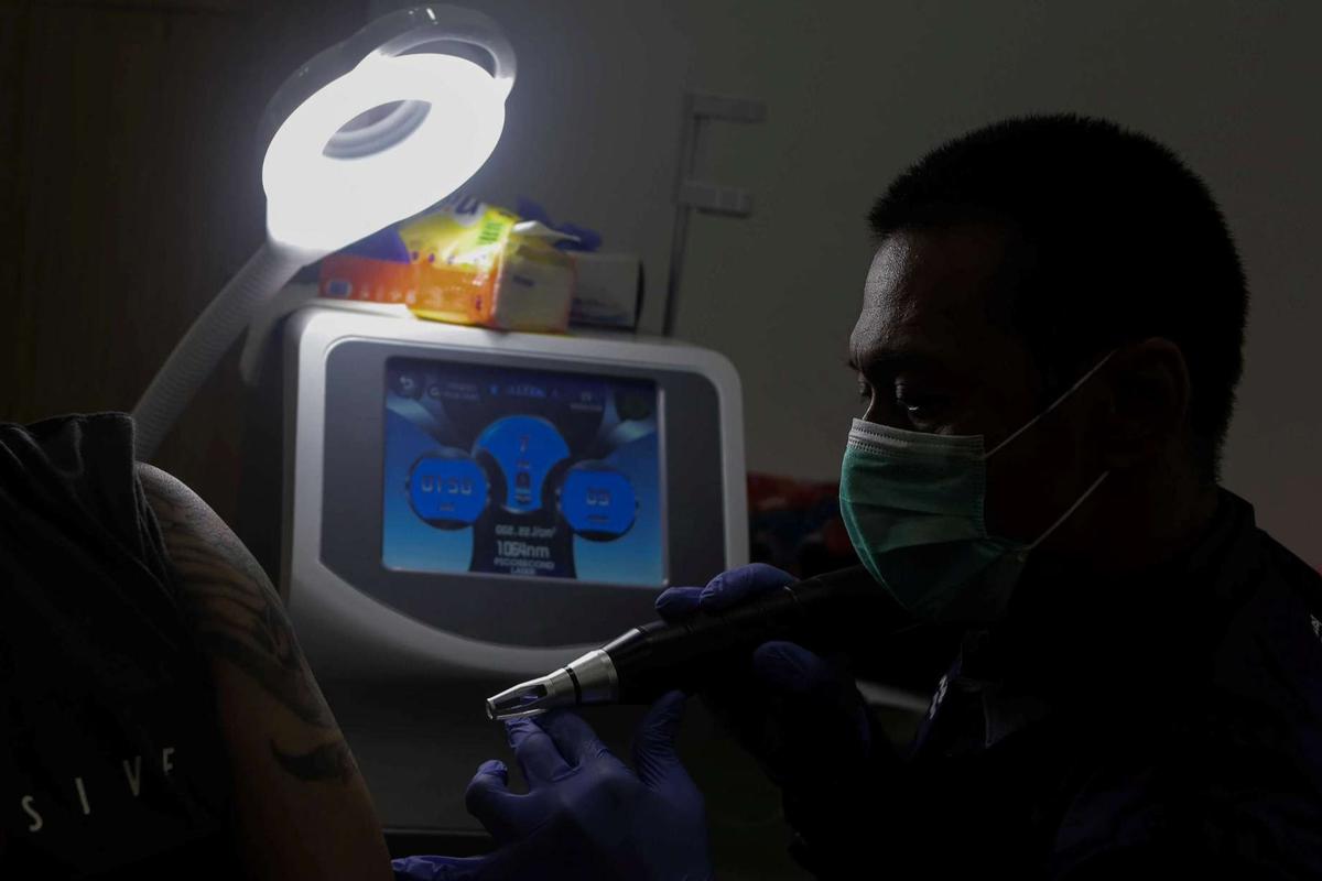 Layanan Hapus Tato Gratis di Jakarta