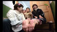 Kondisi unik wanita China, telapak kakinya terbalik. (Huffington Post)