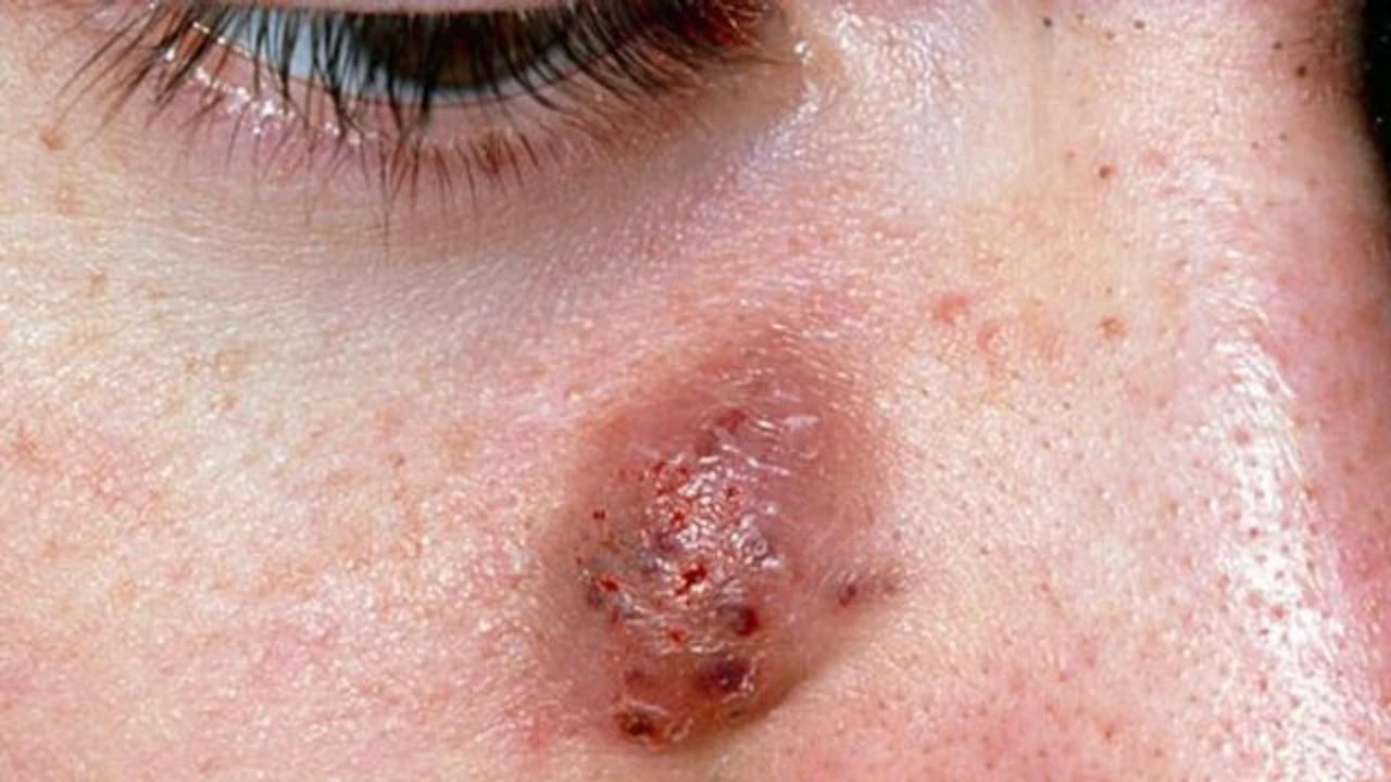 Bisul Membandel? Ini Rekomendasi Obat Herbal yang Terbukti Ampuh