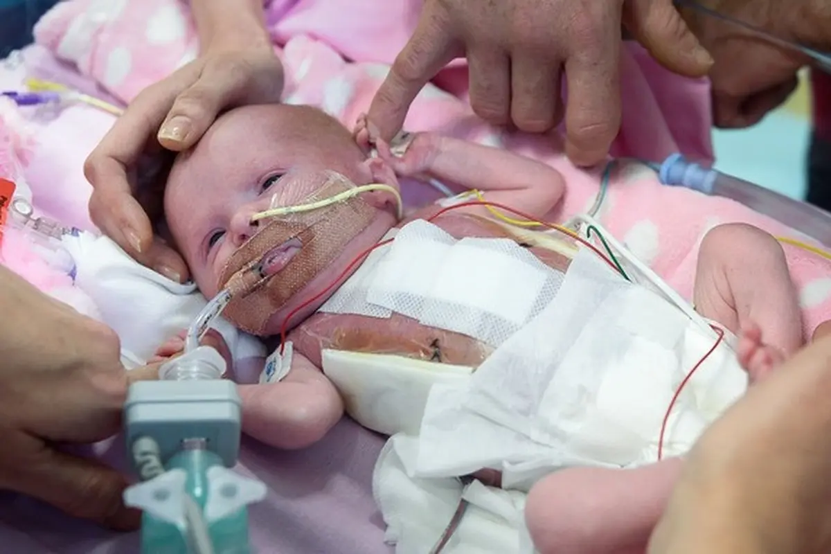 Organ Jantung Keluar Dari Tubuh, Bayi ini Tetap Selamat