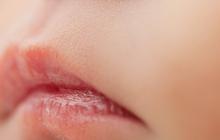 Penyebab Bibir Kering pada Anak, Begini Cara Mengatasinya