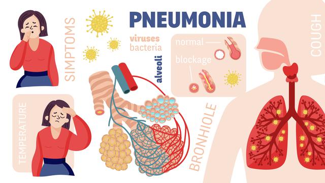 Ilustrasi pneumonia