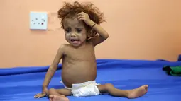 Seorang anak Yaman menderita malnutrisi menunggu menerima perawatan di sebuah rumah sakit di kota Hodeidah, Yaman (8/4). Jutaan orang kelaparan di Yaman setelah dua tahun konflik antara koalisi pimpinan Saudi dan pemberontak Houthi. (AFP Photo/Abdo Hyder)