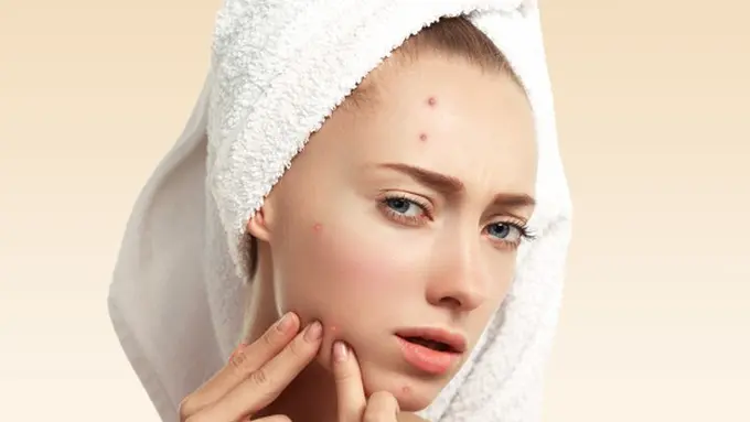 4 Kandungan Skincare yang Paling Ampuh untuk Basmi Jerawat
