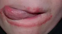 Kenali penyebab dan penanganan kulit kering di pinggir bibir