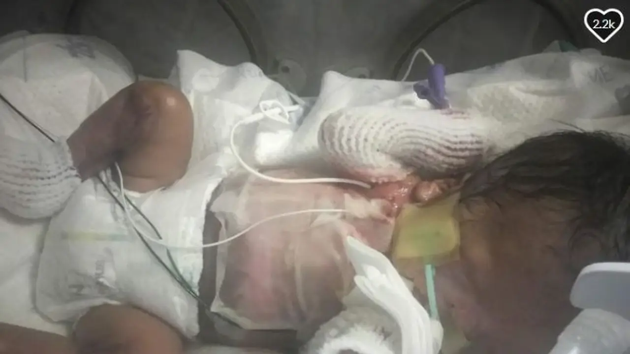 Ja'bari, bayi berusia tiga bulan yang hampir tidak memiliki kulit (Foto: Screen Grab GoFundMe)