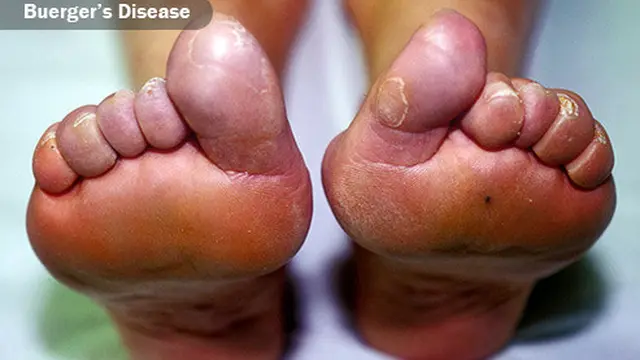 Penyakit Buerger Disease
