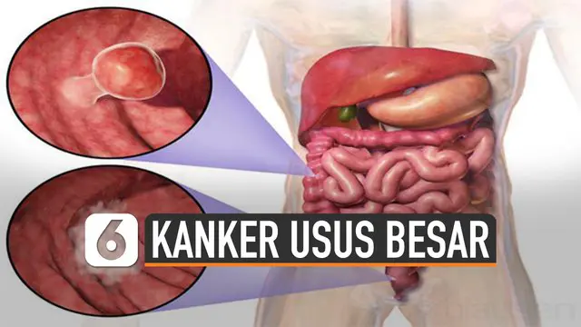 VIDEO: Gejala Kanker Usus Besar yang Sering Tak Disadari