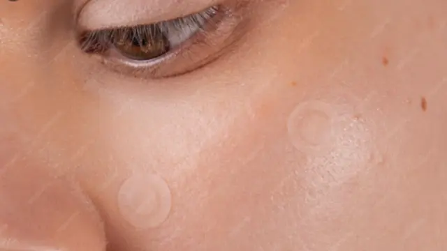 Bagaimana Cara Kerja Acne Patch?