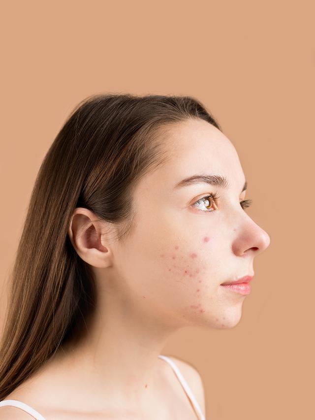 ilustrasi jerawat (Photo by Anna Nekrashevich: https://www.pexels.com/photo/close-up-photo-of-a-teenager-with-pimples-on-her-face-6476065/)