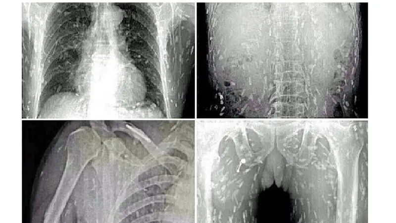 Gambar x-ray penikmat sashimi terinfeksi cacing pita.