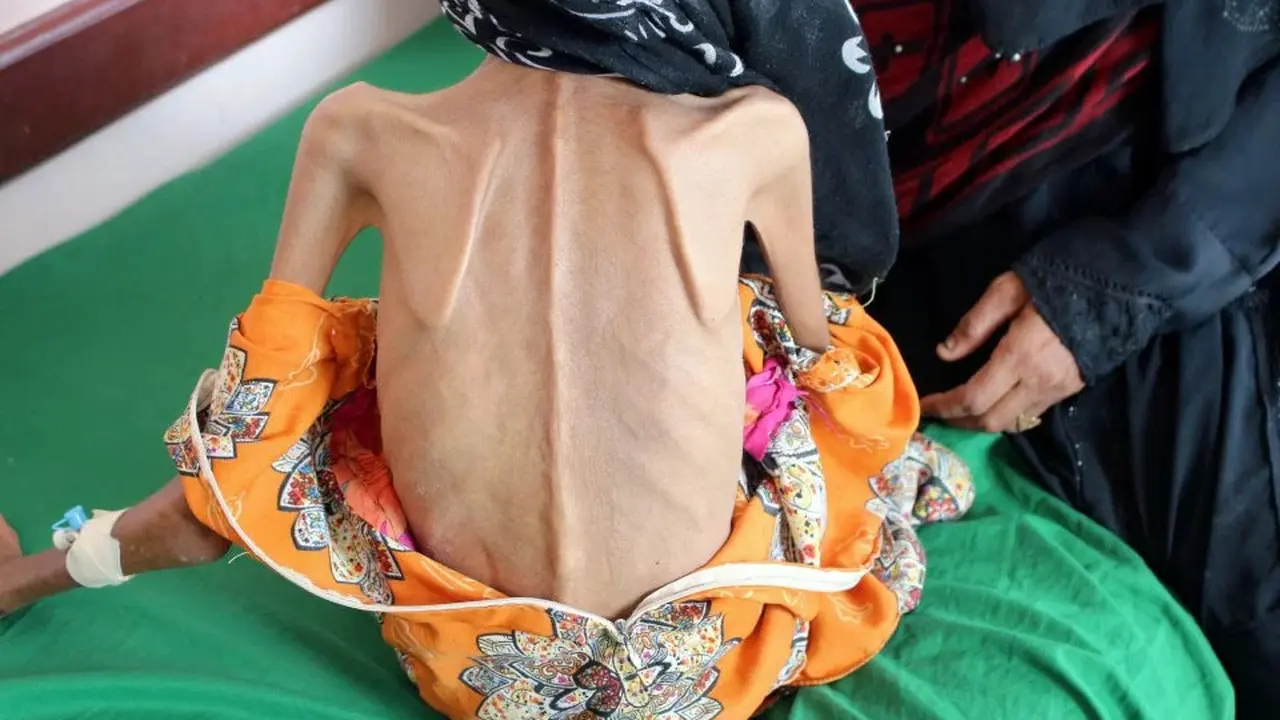 Kisah Pilu Gadis Malnutrisi Korban Perang