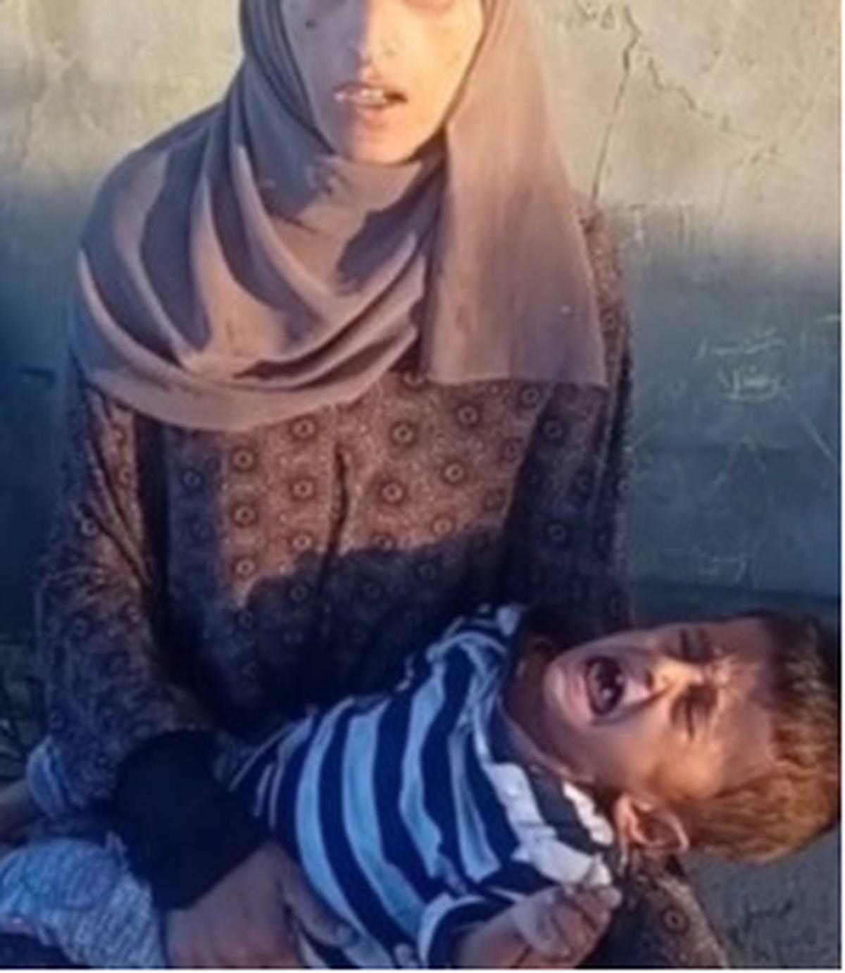 Anak di Gaza Alami Gizi Buruk