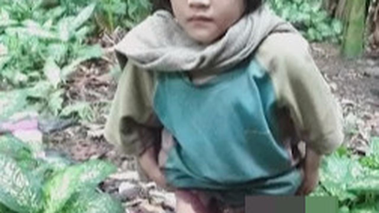 Potret Pilu Bocah Yatim Alami Cacat Fisik hingga Kaki Bengkok