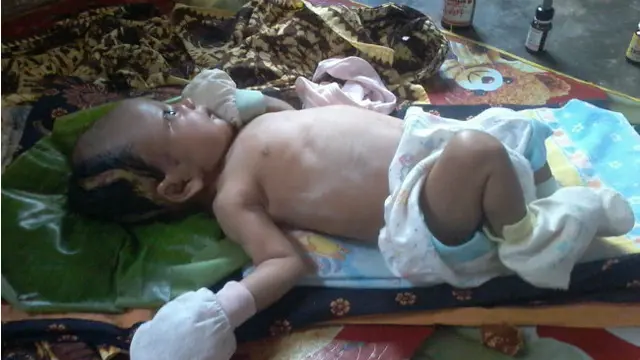 Derita Pembengkakan Pembuluh Darah, Anak Buruh Harian Lepas di Tapteng Butuh Uluran Tangan Dermawan